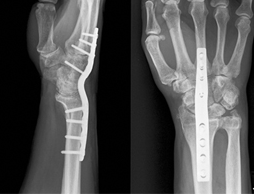 Radiographie d'une arthrodèse du poignet