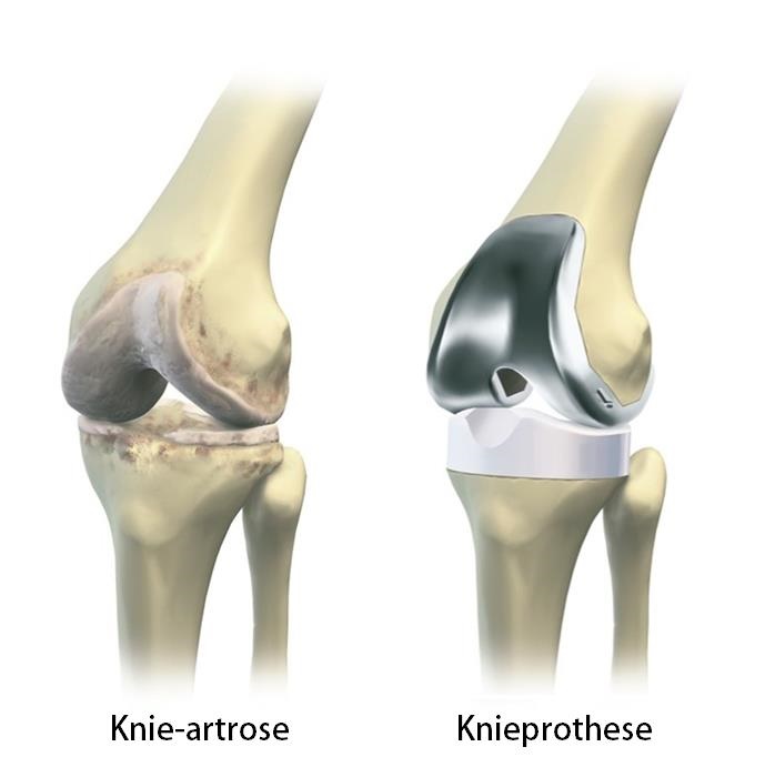 Quel type de prothèse du genou vous convient le mieux ?